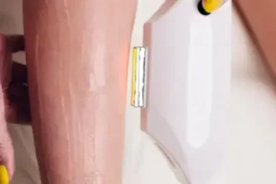 Lazer Epilasyonda Oluşabilecek Komplikasyonlar ve Yan Etkiler